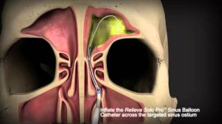 Balloon Sinuplasty Animation  Frontal Sinuses [upl. by Avilla]