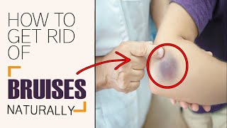 How to Get Rid of Bruises Fast  Home Remedies for Bruises Removal [upl. by Rooker]