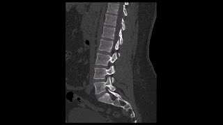 Lumbar Spine CT Normal No Pathology [upl. by Ree]