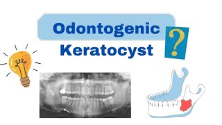 Odontogenic Keratocyst OKC  Oral Pathology  Dental lectures [upl. by Branen691]