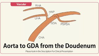 Aorta to GDA from Duodenum [upl. by Eocsor]