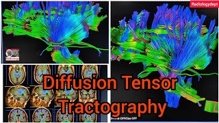 Diffusion Mri Fiber Tensor imaging tractography of the Brain  Siemens tractography in Hindi Mri [upl. by Lleddaw271]