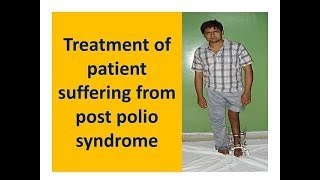 Treatment of patient suffering from post polio syndrome [upl. by Yenrab]