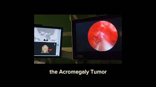 surgery for gh secreting adenoma in patient with mccune albright syndrome with fibrous dysplasia [upl. by Anoid826]