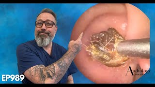 The MOST SATISFYING ring of dry ear wax removal EP989 [upl. by Willis]