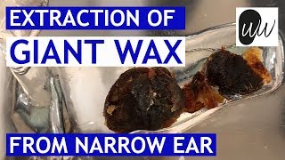 Extraction of GIANT WAX from Narrow Ear Canal Entrance  393 [upl. by Brand]