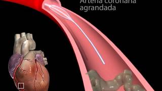 Angioplastia con balón segmento corto  Medicina y Cirugia [upl. by Enelia]