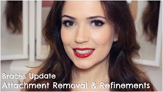 Invisalign  Attachments Removal amp Refinements [upl. by Waring761]