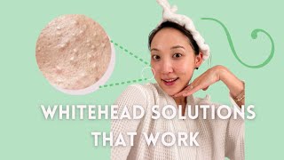 WHITEHEADS aka those annoying tiny white bumps  Main Causes amp How To Get Rid of Them Long Term [upl. by Had]