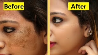 How to Remove Skin pigmentation from face  Beauty Tips in Tamil [upl. by Bethanne749]