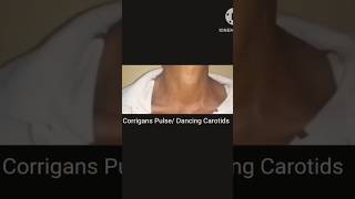 Corrigans Pulse  Dancing Carotids  Collapsing Pulse  water Hammer Pulse [upl. by Yzzo]