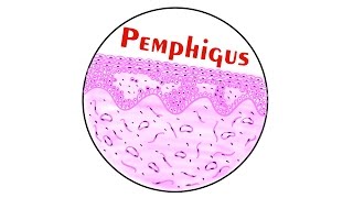 Pemphigus  Histopathology [upl. by Nahs]