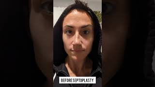 Before and After Septoplasty and Turbinate Reduction  2 Weeks Later [upl. by Koorb]