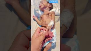 Skin Type Very Poormedical newbornbaby viralvideo [upl. by Nannarb]