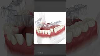 How Does Invisalign Aligners Work To Straighten Teeth [upl. by Ahsinert]