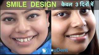 Teeth Gap Treatment in 5 Days I Zirconia Cap I Best Smile Design Dentist in INDIA youdent ​ [upl. by Gipson]