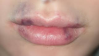 how to get rid of bruising after lip fillers tutorial [upl. by Hewitt]