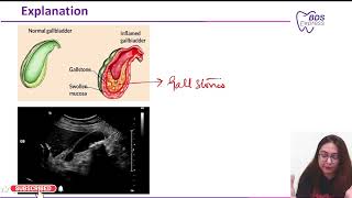 NEET MDS 2023 General Surgery  Acute cholecystitis [upl. by Kurr626]