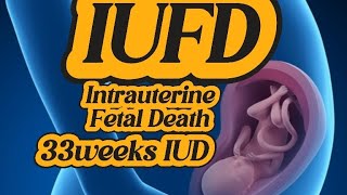 IUFD  Intrauterine Fetal Demise  Intrauterine Fetal Death  33weeks IUD  Fetal Gender [upl. by Alika233]