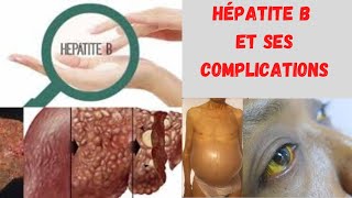 Lhépatite B Tout savoir sur le virus de lhépatite B ses complications et comment léviter [upl. by Assennej]