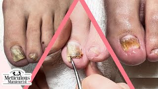 How to Fix Toenails that Change Shape and Color [upl. by Ennazor]