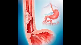 Diseases of the esophagus part 1 by ASM Minds [upl. by Monteith]