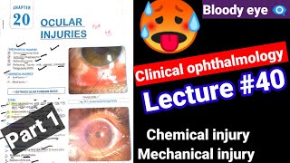 🔴Clinical ophthalmology lectures 40 ocular injuriesmechanicalchemical injury Contusion Hypema [upl. by Shiau]