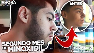 SEGUNDO MES USANDO MINOXIDIL  TRATAMIENTO PARA LA BARBA [upl. by Ainahs]