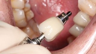 Full Contour Zirconia Implant Crown Insert [upl. by Michelle696]