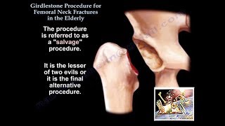 Girdlestone Procedure Hip Fractures Elderly  Everything You Need To Know  Dr Nabil Ebraheim [upl. by Schultz]