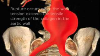 Ruptured Abdominal Aortic Aneurysm [upl. by Amelia531]