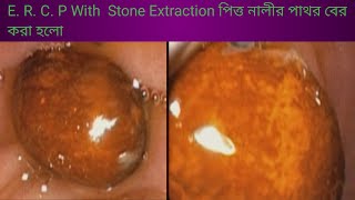 E R C P With Stone Extraction ইআরছিপি পিত্ত নালীর পাথর বের করা হলো l l Endo Cut [upl. by Morvin]