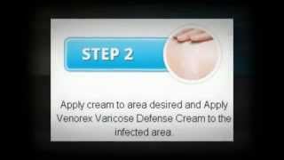 Venorex Varicose Vein Cream Reviews [upl. by Adnicaj632]