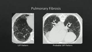 HRCT Pneumoconiosis [upl. by Einitsed]