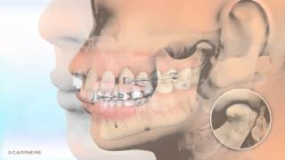 Carriere® Motion™ Appliance for Class II Patients  Braces and Invisalign Ortho  Madison GA [upl. by Maddie]