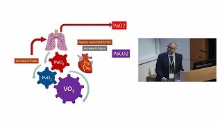 How do I ventilate my Hypercapnic Patients Dr Luigi Camporota [upl. by Eivol]