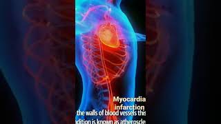 myocardial infarction for further information visit our channel and subscribe [upl. by Otrepur]