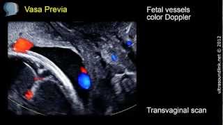 Vasa Previa  ultrasound diagnosis [upl. by Sarnoff]