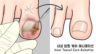 ASMR 시원함 주의 리얼한 내성 발톱 케어 애니메이션  Ingrown Toenail removal treatment animation [upl. by Aleafar]