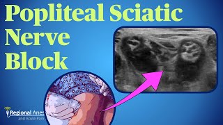 Popliteal Sciatic Nerve Block [upl. by Nonez]