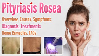 Pityriasis Rosea Overview Causes Signs and Symptoms Diagnosis Treatment Home Remedies and FAQs [upl. by Syhr268]