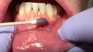 Dr Laurence Rifkin Treatment of Mouth Ulcer [upl. by Shauna]