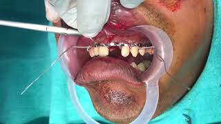 Arch Bar Fixation for Maxillary Dentoalveolar Fracture  Dr Sunil Richardson [upl. by Ellered]