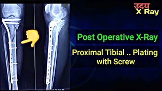 Fracture Proximal TibiaFibula  Post Operative TibiaFibula XRay  Uday XRay [upl. by Harbert]