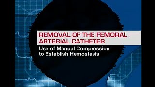 How to pull an arterial femoral sheath [upl. by Hilar332]