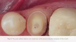 How to complete a post procedure using FibreKleer 4x Fiber Posts [upl. by Akinam]