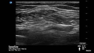 Ultrasound Guided Popliteal Sciatic Nerve Blockade with Catheter Placement [upl. by Ecinuahs]