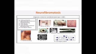 Neurofibromatosis mrcpch Clinical [upl. by Eugenides294]