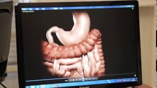 Gastrik Bypass Ameliyatı Nedir ProfDr Oktay Banlı [upl. by Alakcim]