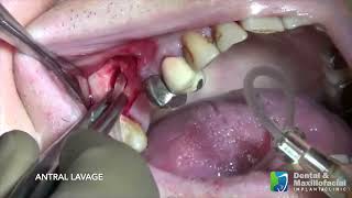 MAXILLARY SINUS CYST ENUCLEATION WITH ANTRAL LAVAGE [upl. by Ahtram18]